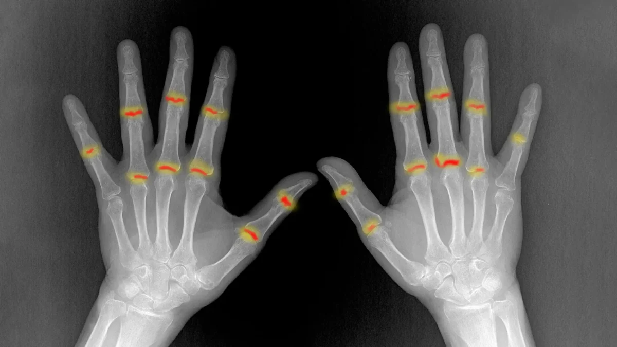 Arthritis Risk May Begin Before Birth