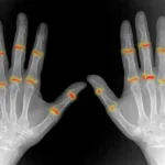Arthritis Risk May Begin Before Birth